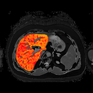 Corrected T1 (cT1) Image